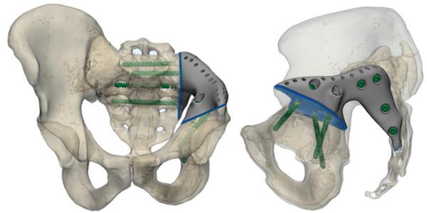 3D-модель тазобедренного сустава